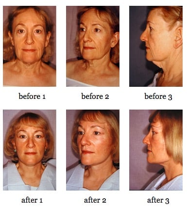 facelift before and after