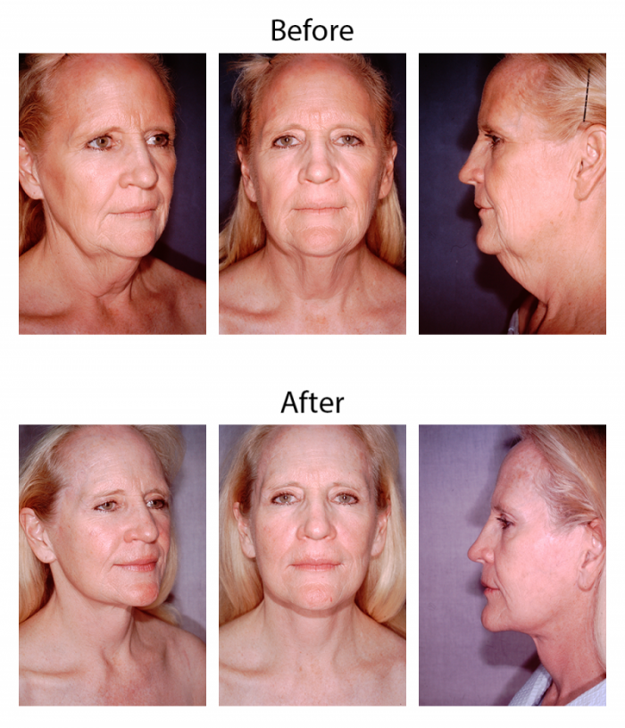 female facelift before and after