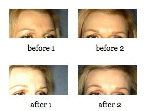 Eyebrow Lift, Forehead Lift, or Brow Lift before and after