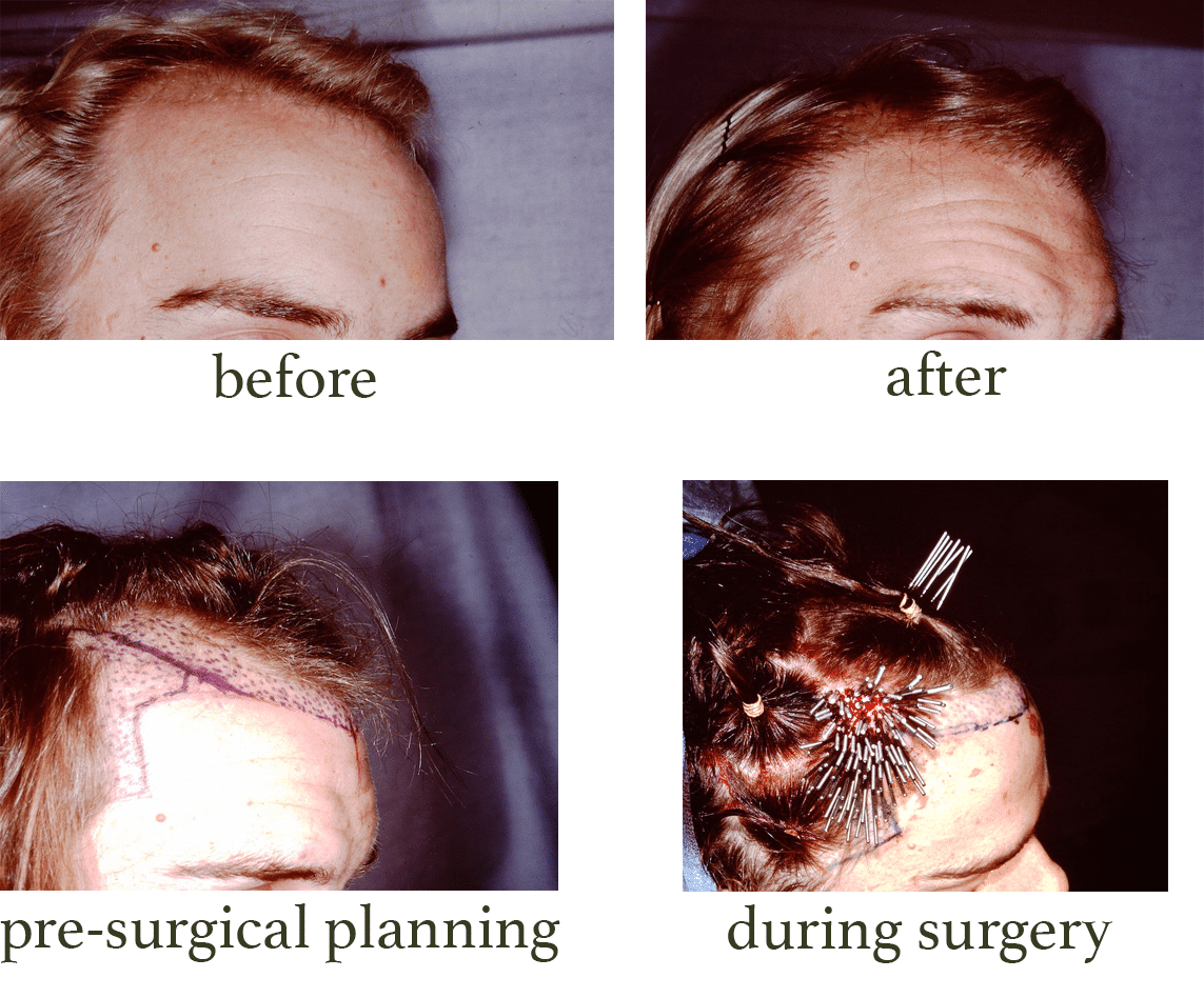 Before and after pictures of hair transplant surgery