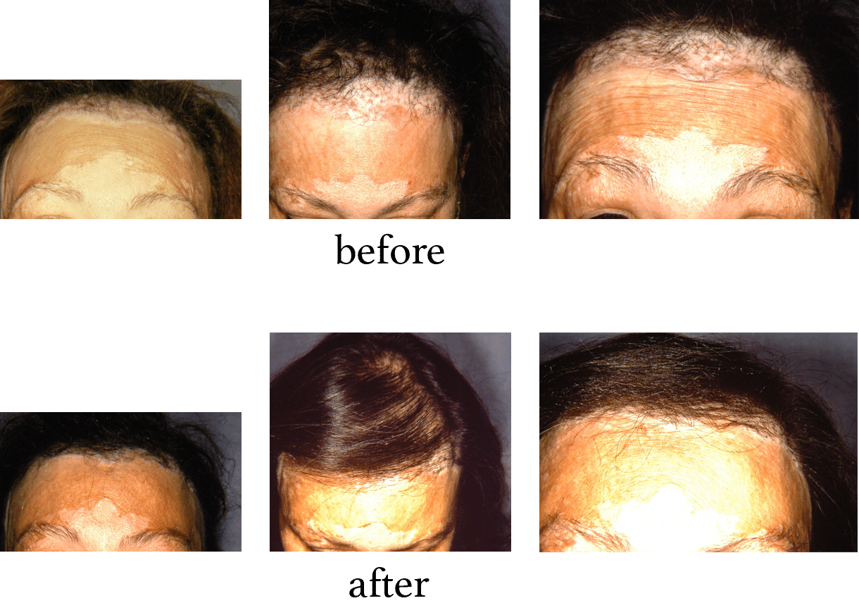 Hair Restoration Surgery