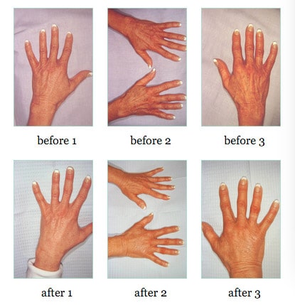 hand rejuvenation before and after