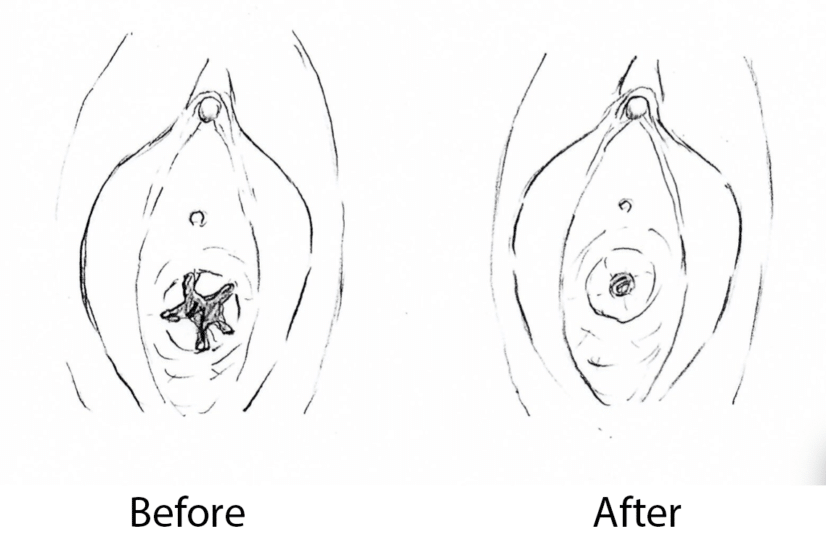 Hymenoplasty