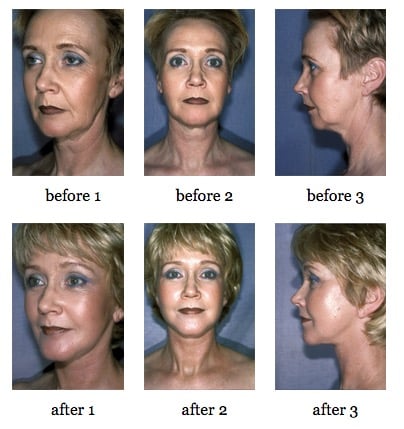 Facial Implants before and after