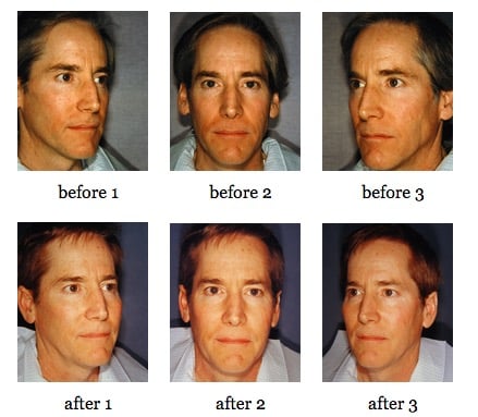 Facial Implants before and after