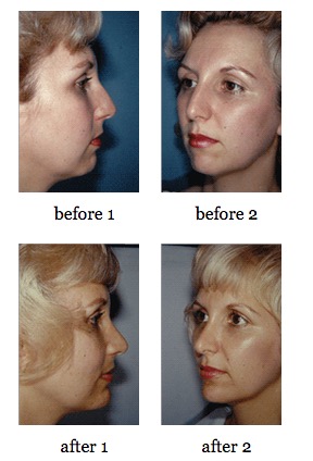 Facial Implants before and after