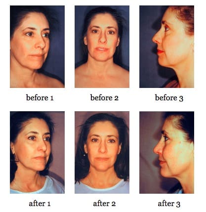 Facial Implants before and after