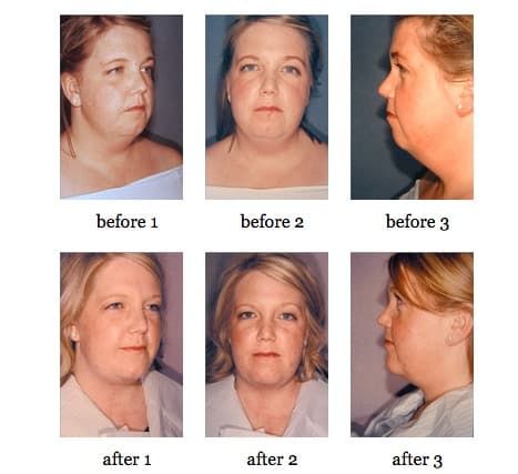 Facial Implants before and after