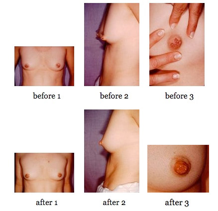breast deformities before and after