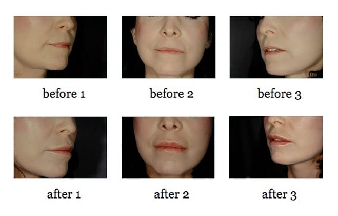 Lip Augmentation before and after