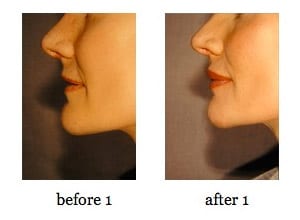 lip-augmentation1