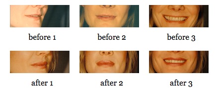 Lip Augmentation before and after