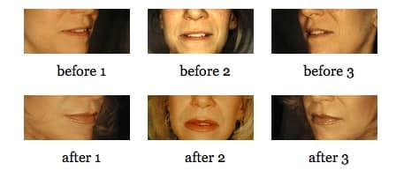 Lip Augmentation before and after