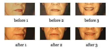 Lip Augmentation before and after