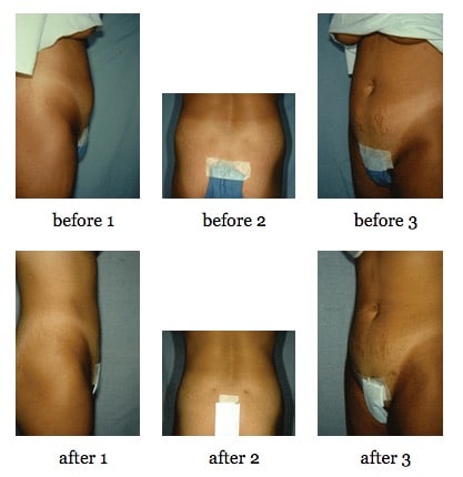 Tummy tuck before and after