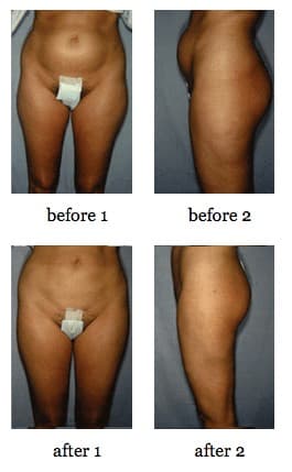 Tummy tuck before and after