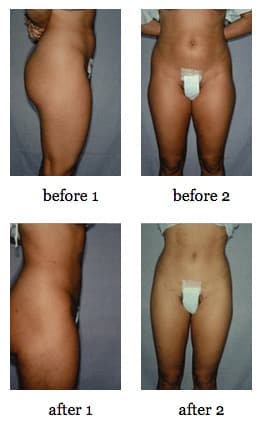 Tummy tuck before and after