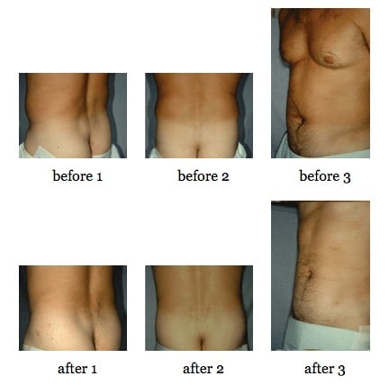 Tummy tuck before and after