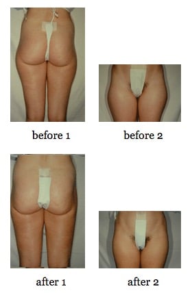 Tummy tuck before and after