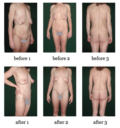 Lower Body Lift - Salt Lake City  Fairbanks Plastic Surgery Center