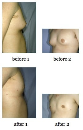 male breast reduction before and after