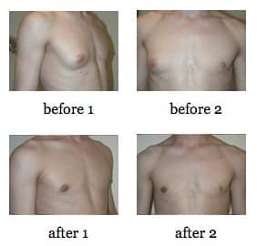 male breast reduction before and after