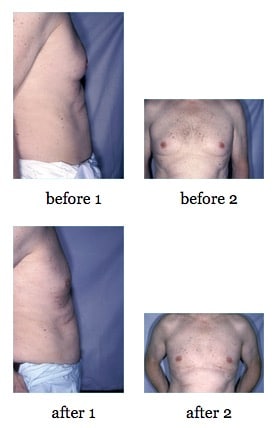 male breast reduction before and after