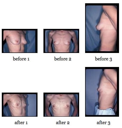 Nipple Sparing Mastectomy before and after