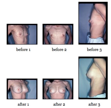 Nipple Sparing Mastectomy before and after