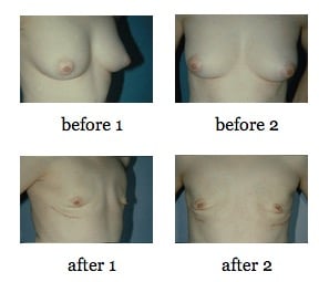 Nipple Sparing Mastectomy before and after