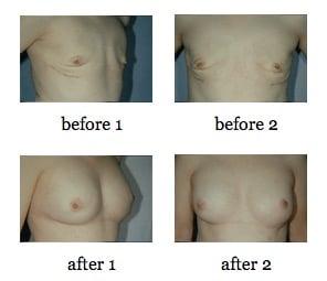 Nipple Sparing Mastectomy before and after