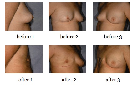 Nipple Sparing Mastectomy before and after