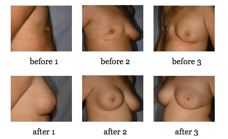 Nipple Sparing Mastectomy before and after