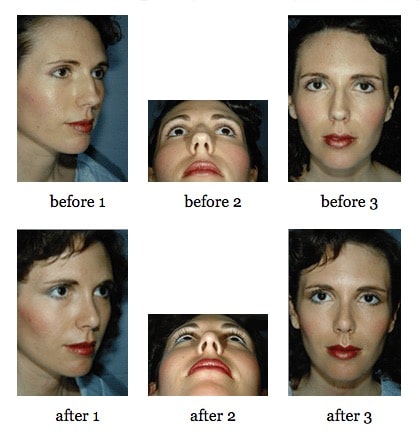 Rhinoplasty before and after