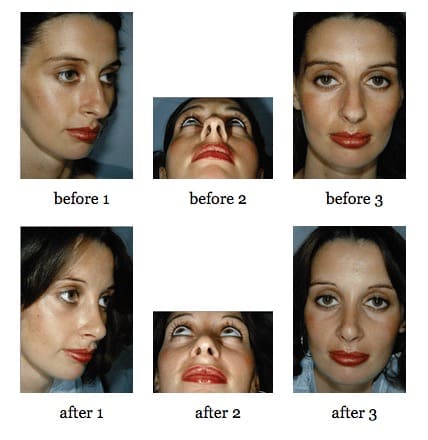 Rhinoplasty before and after