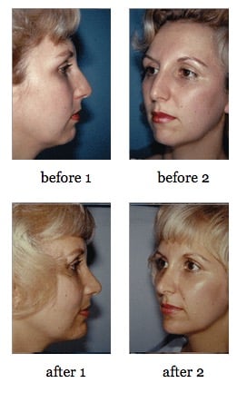 Rhinoplasty before and after