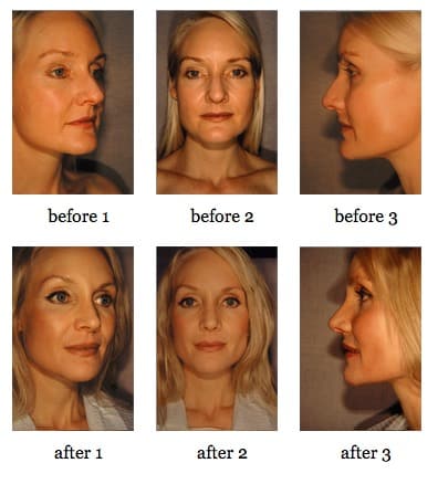 Rhinoplasty before and after