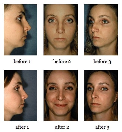 Rhinoplasty before and after