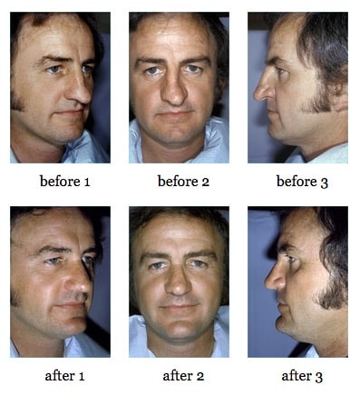 Rhinoplasty before and after