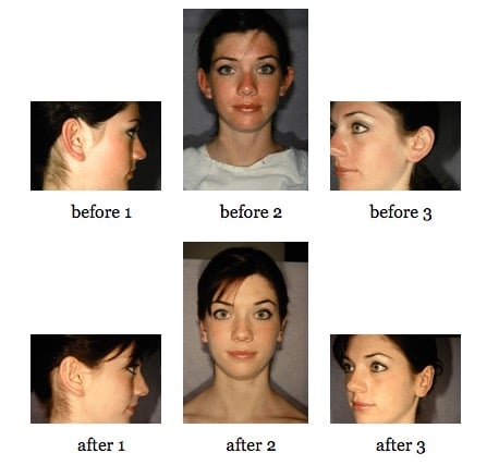 otoplasty before and after