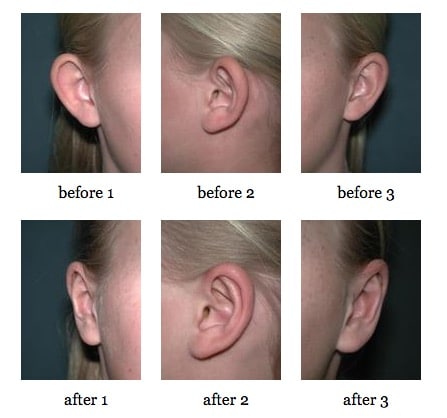 otoplasty before and after