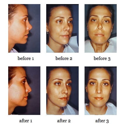 Secondary Rhinoplasty before and after