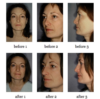Secondary Rhinoplasty before and after