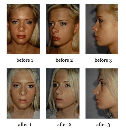Secondary Rhinoplasty before and after