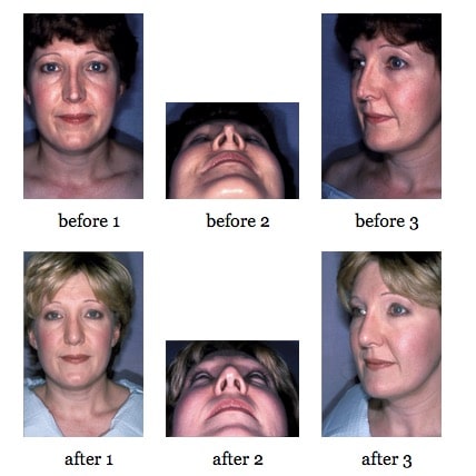 Secondary Rhinoplasty before and after