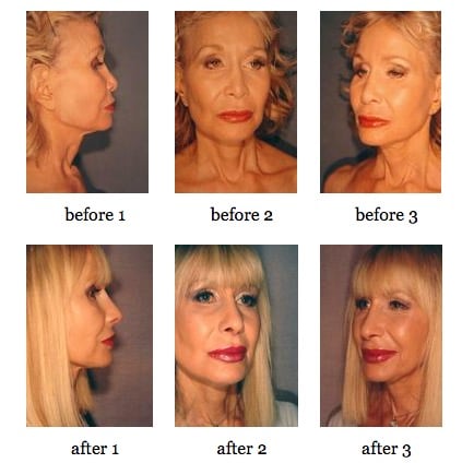 Secondary Rhinoplasty before and after