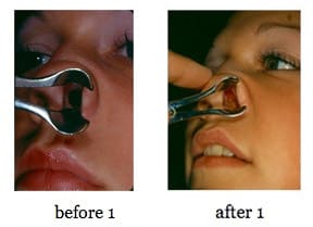 septum-repair