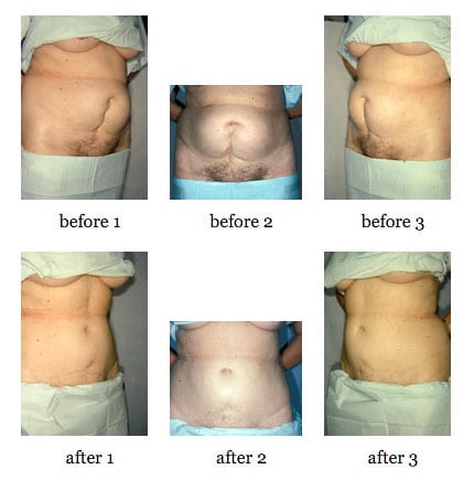 Tummy tuck before and after