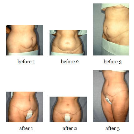 Tummy tuck before and after