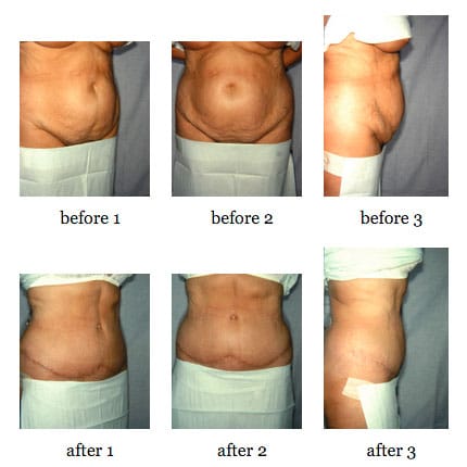 Tummy tuck before and after